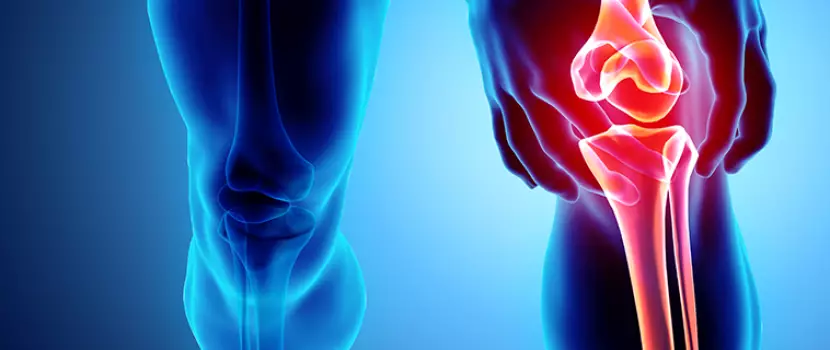 a második fokú térd deformáló artrózisa a calcanealis ízület osteoarthritisének kezelése